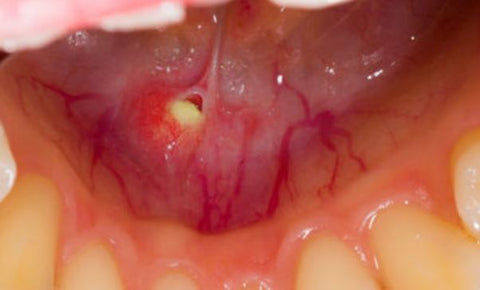 Salivary stone removal